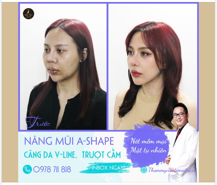 THÀNH CÔNG NÂNG CẤP NHAN SẮC CHỈ VỚI COMBO Nâng mũi Ashape Trượt cằm Căng da mặt VLine