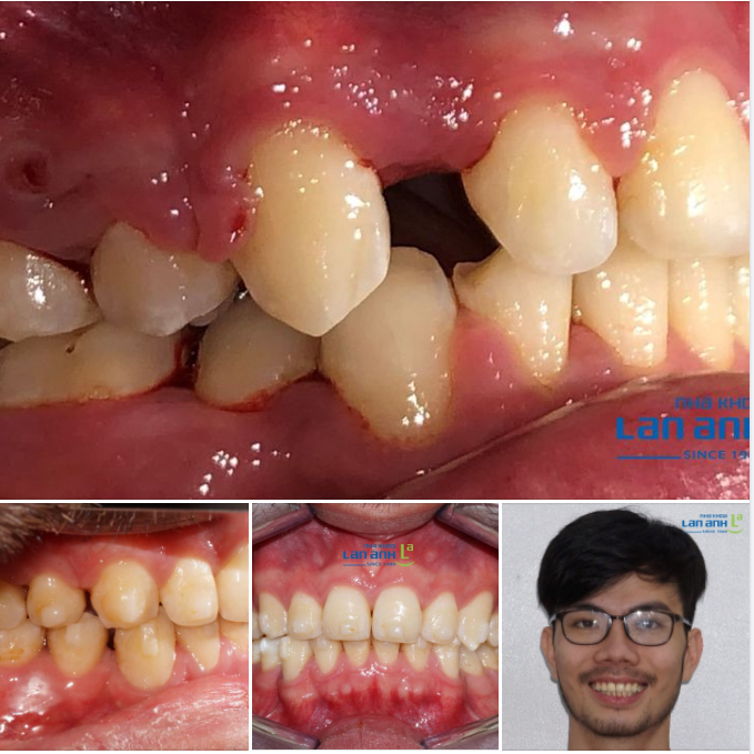 Hồi xưa răng mình niềng nơi khác bị hư tùm lumy... Mà giờ nha khoa Lan Anh chỉnh lại cũng ổn hơn trước nhiều rồi!