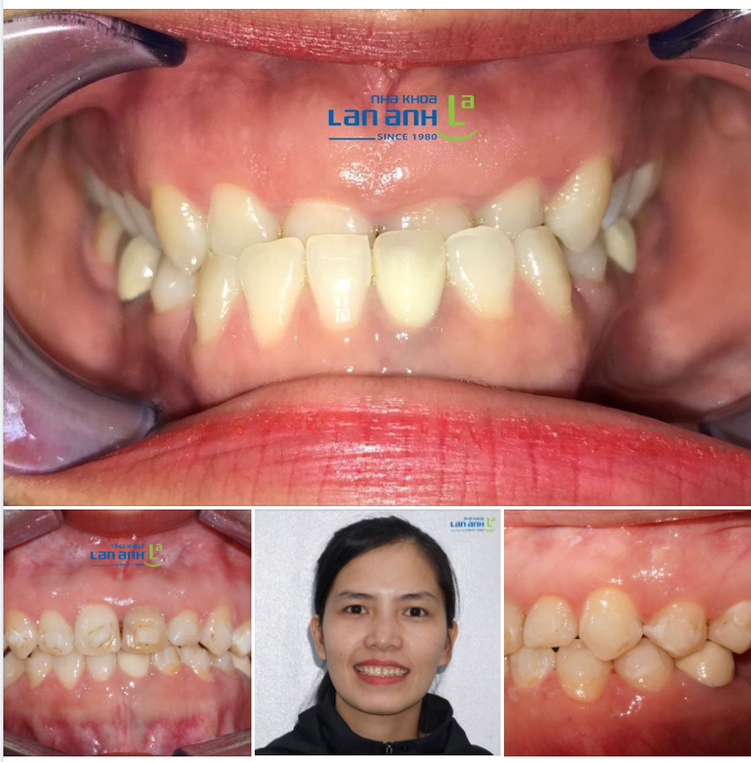  Một ca niềng cắn ngược bằng Invisalign, tại nha khoa Lan Anh Phú Nhuận!