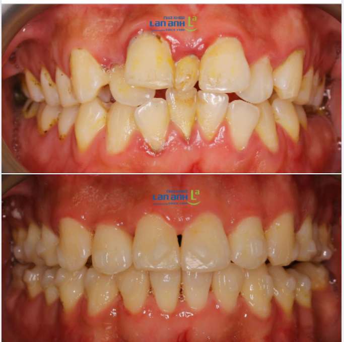 Một ca niềng Invisalign tại chi nhánh Sala, quận 2!