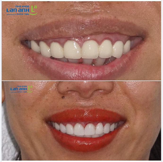 Một ca phục hình răng sứ thẩm mỹ của bác sĩ Huyền, chi nhánh Phú Nhuận!