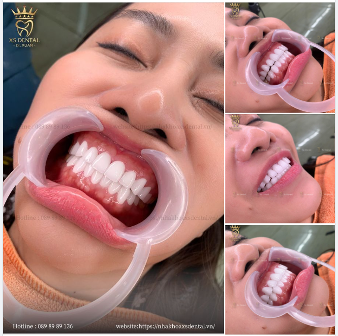 Nha khoa Xs hoàn thành trọn bộ 20 răng sứ cao cấp Orodent Bleach cho khách hàng .