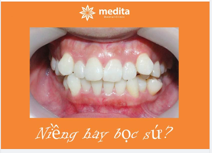 RĂNG KHẤP KHỂNH NÊN NIỀNG HAY BỌC SỨ?