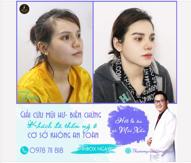 HẾT LO ÂU! VÌ MŨI XẤU