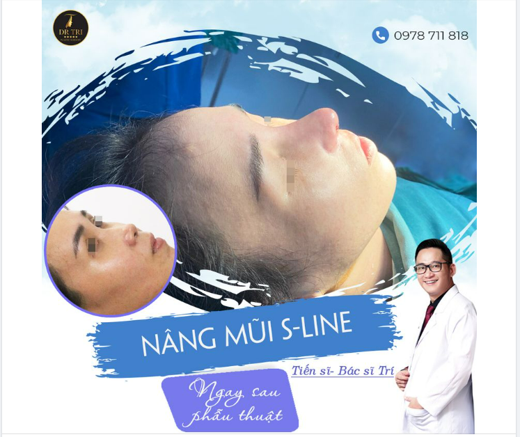 XONG CA NÂNG MŨI SLINE CHO KHÁCH CÓ MŨI THẤP TẸT