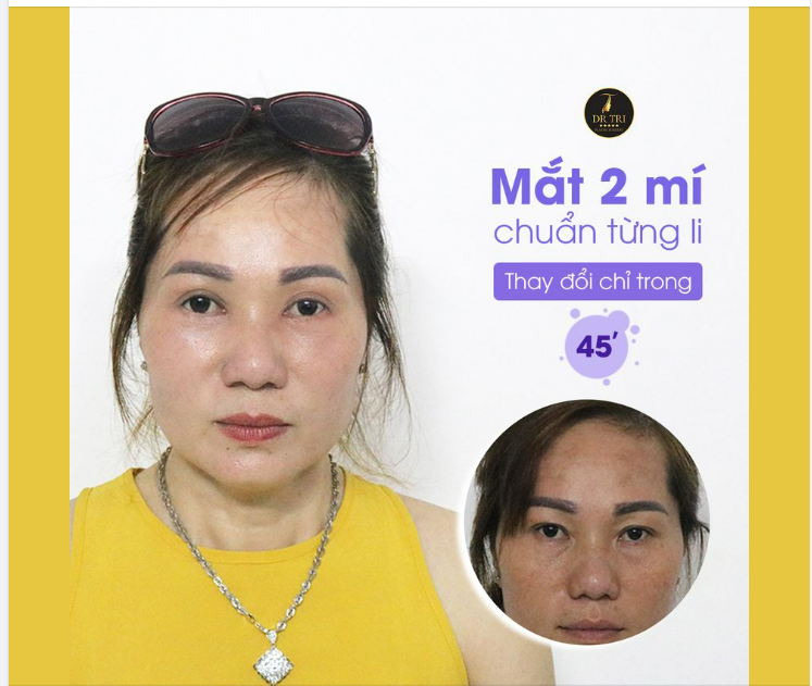 MÍ CHUẨN TỪNG LI - NHỜ DR.TRÍ