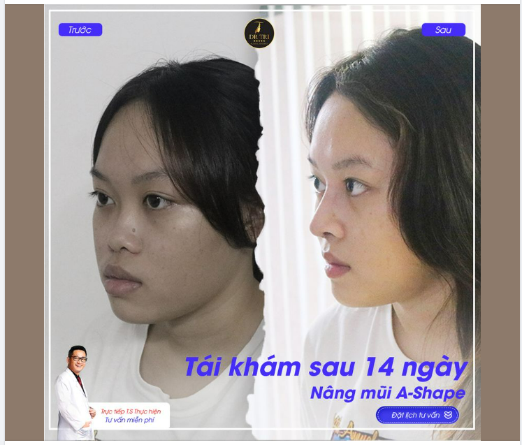 Tái khám sau 14 ngày nâng mũi Ashape