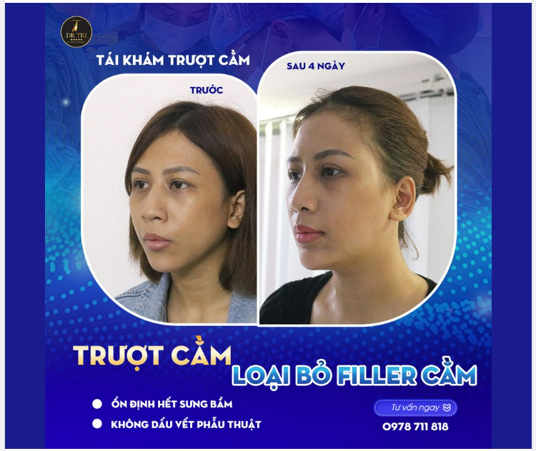 Cô gái đã tiêm filler để khắc phục dáng cằm ngắn lẹm.