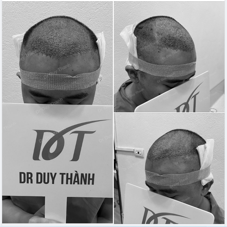 CẤY 2100 NANG TÓC SẼ NHƯ NÀY NHÉ - TRẢ KẾT QUẢ KHÁCH VŨNG TÀU HÔM TRƯỚC.