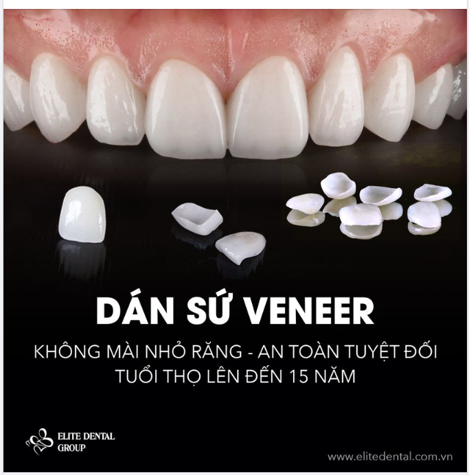 Dán sứ veneer có bền không?