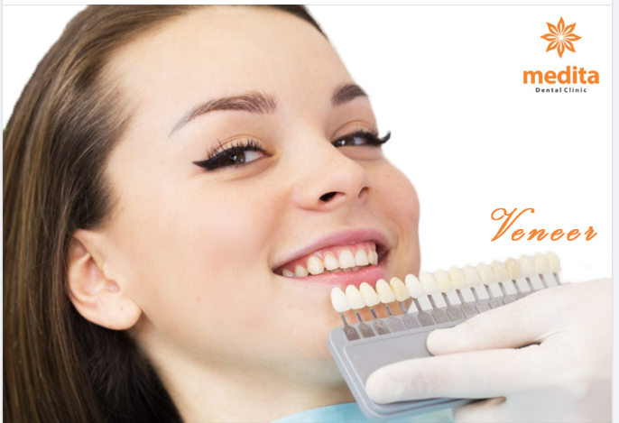 DÁN SỨ VENEER