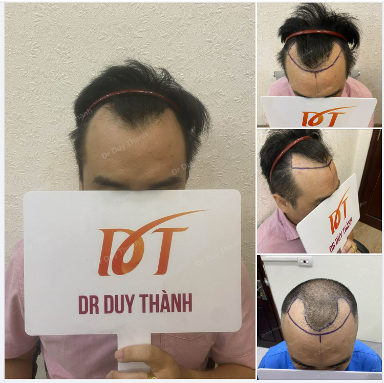 ĐẦU TUẦN CHUẨN BỊ CẤY 1700 NANG TÓC BOY NHA TRANG 34 TUỔI
