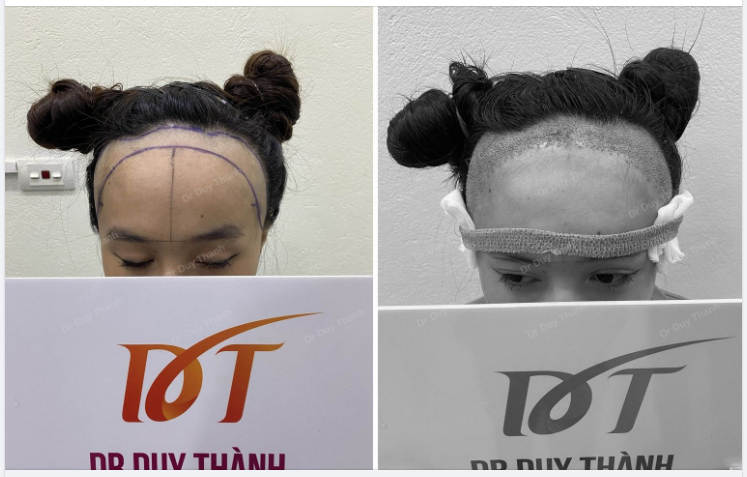 HÌNH ẢNH TRƯỚC- SAU CẤY 1600 NANG TÓC HẠ TRÁN DÔ