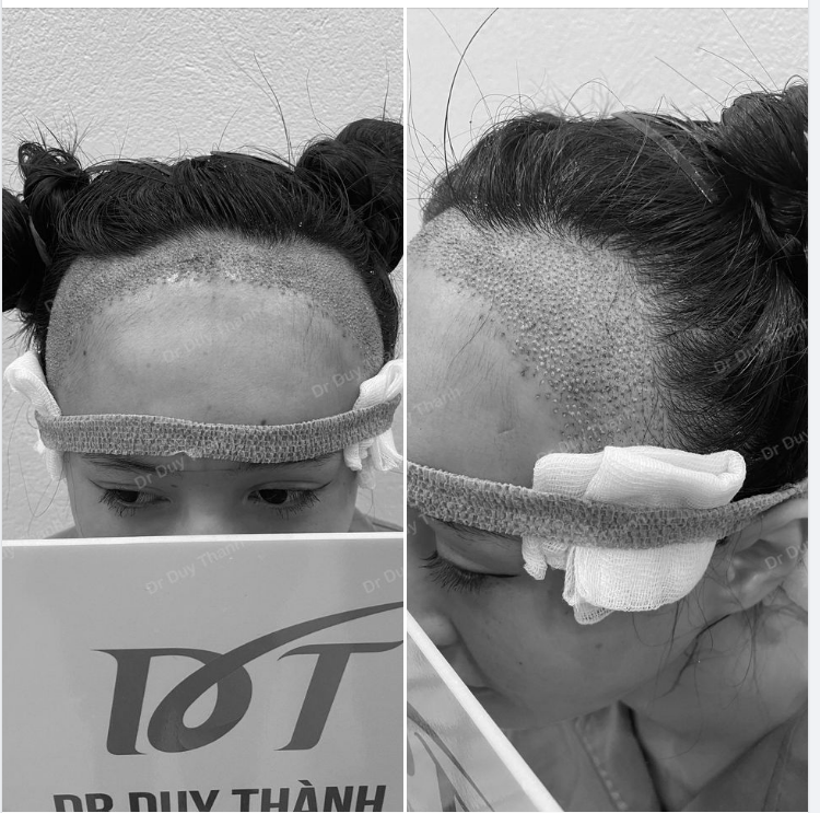KẾT QUẢ CẤY 1600 NANG TÓC KHẮC PHỤC TRÁN CAO CHO KHÁCH NỮ.