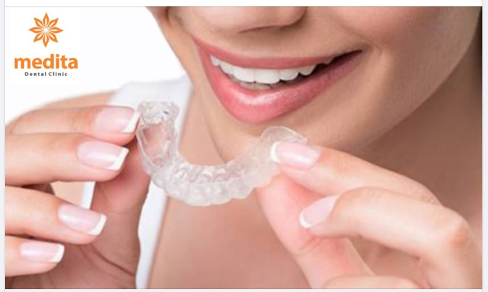 Khay niềng Reveal Clear Aligners, bạn đã biết chưa?