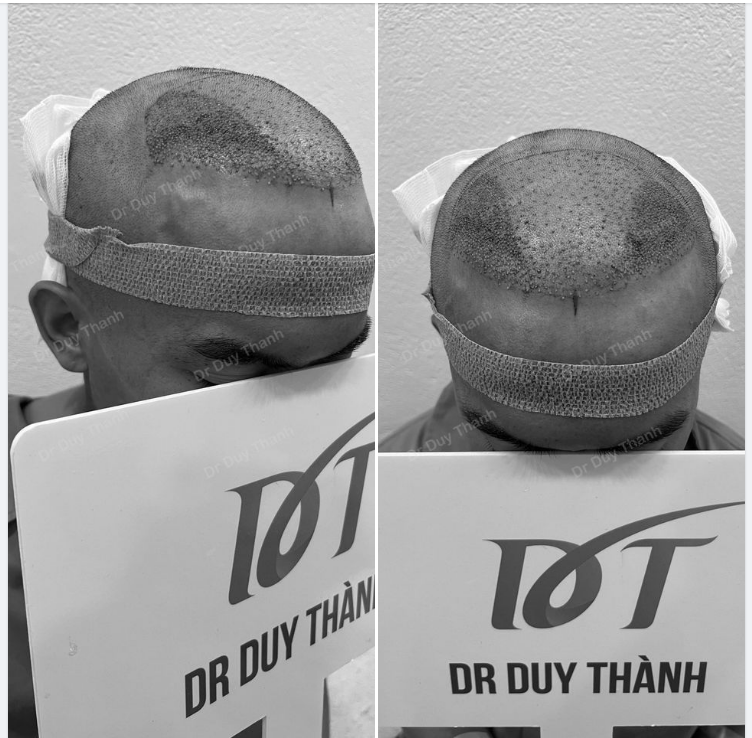 TRẢ KẾT QUẢ CẤY 1500 NANG TÓC KHÁCH HÀ NỘI 30 TUỔI NGÀY HÔM QUA