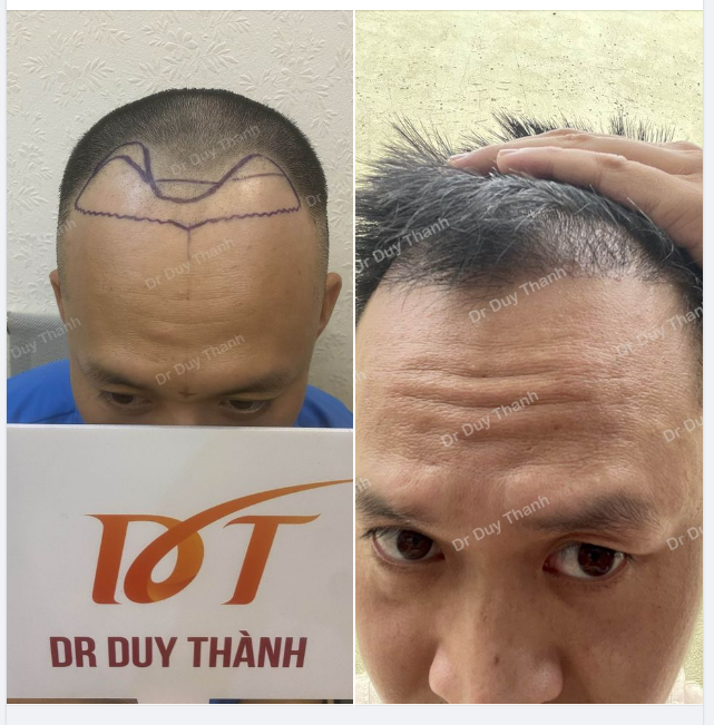 KẾT QUẢ SAU 3 THÁNG 19 NGÀY CẤY TÓC