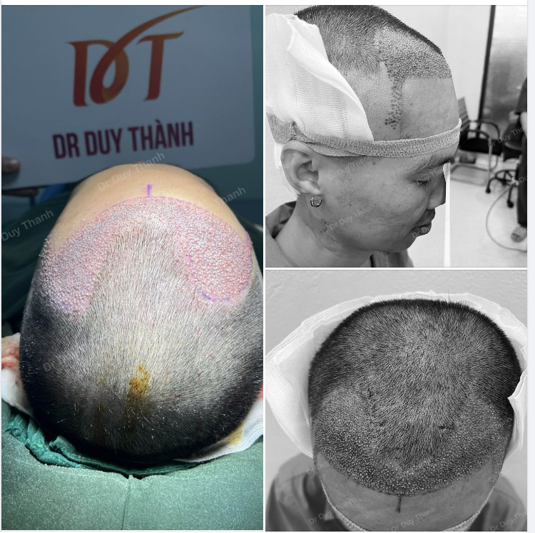 TÁC PHẨM CẤY 2000 NANG TÓC BOY PHÚ YÊN NGÀY HÔM QUA