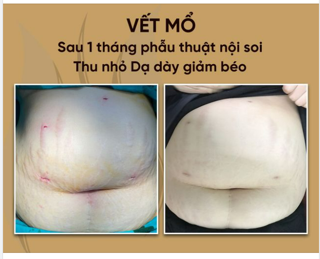 Một trong những ưu điểm vượt trội của phương pháp phẫu thuật nội soi thu nhỏ dạ dày điều trị béo phì đó là có tính thẩm mỹ cao.