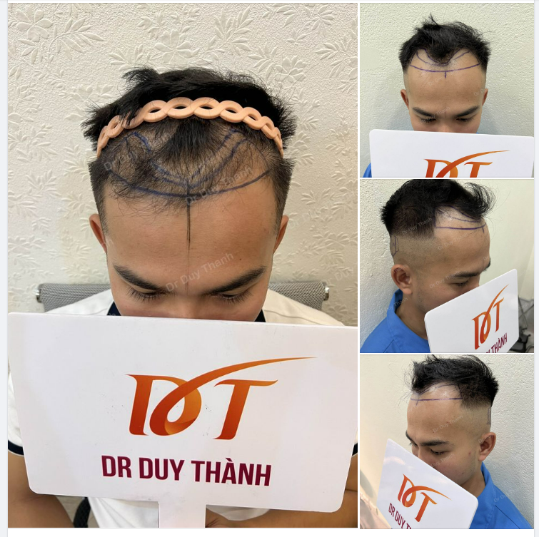 CHUẨN BỊ CẤY 1300 NANG TÓC KHẮC PHỤC HÓI CHỮ M CHO BOY Dak Lak 27 tuổi