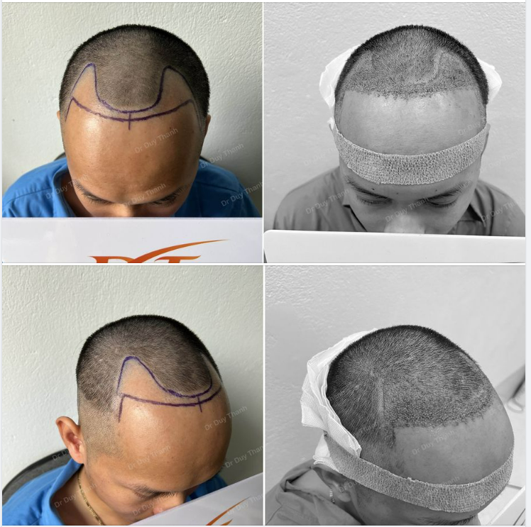 KẾT QUẢ TRƯỚC- SAU CẤY 1500 NANG TÓC BOY HÀ TĨNH 27 TUỔI