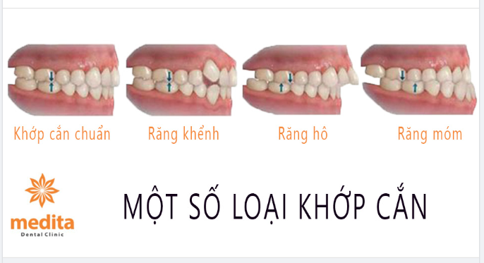 LỆCH KHỚP CẮN