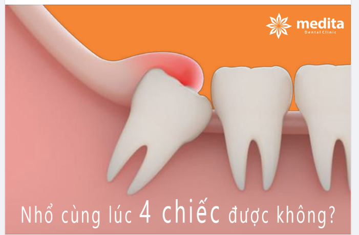 NHỔ 4 RĂNG KHÔN CÙNG LÚC ĐƯỢC KHÔNG?