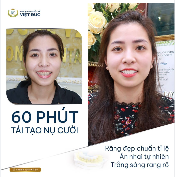 RẠNG RỠ NỤ CƯỜI CHỈ SAU 60 PHÚT