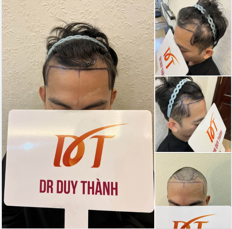 CHUẨN BỊ CẤY 1700 NANG TÓC, BOY NGHỆ AN 29 TUỔI
