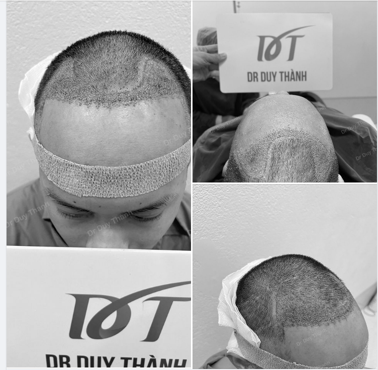 TRẢ KẾT QUẢ CẤY 1500 NANG TÓC, BOY HÀ TĨNH 27 TUỔI - NGÀY HÔM TRƯỚC