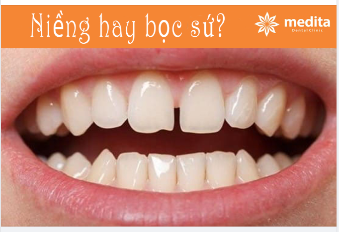 RĂNG THƯA NÊN NIỀNG HAY BỌC SỨ?