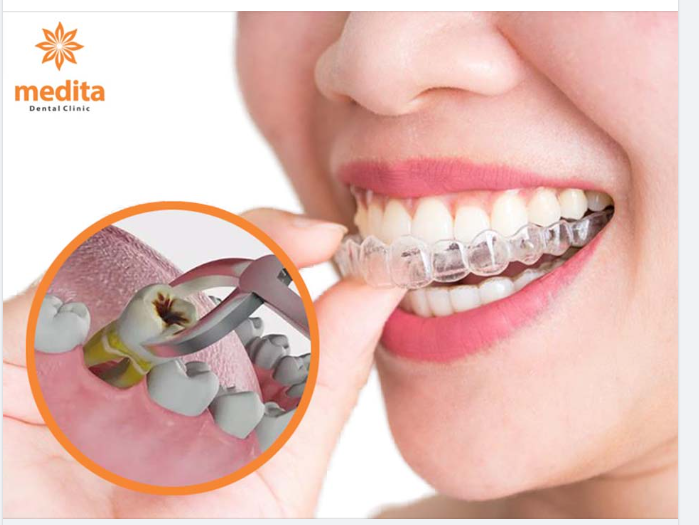 TẠI SAO THƯỜNG NHỔ RĂNG SỐ 4 KHI NIỀNG?