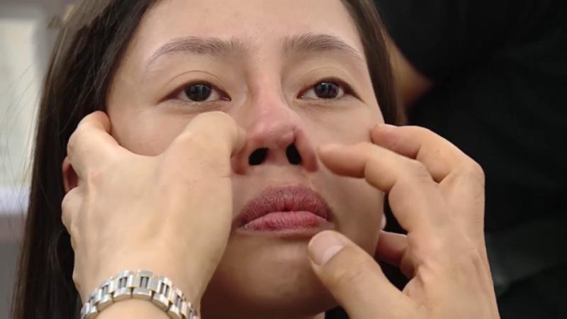 Mổ vẹo vách ngăn mũi khắc phục vấn đề nâng mũi bị lệch