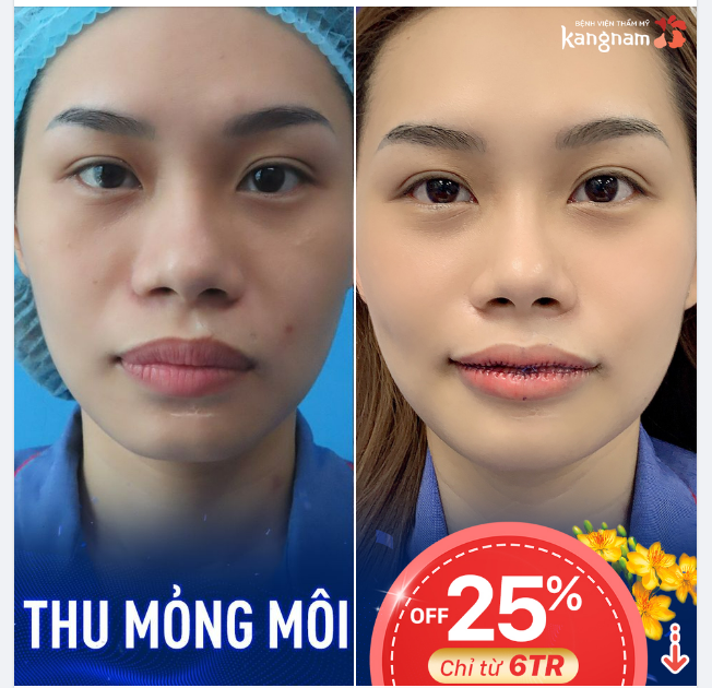 Thu mỏng môi xong mà trẻ ra 3,4 tuổi lận