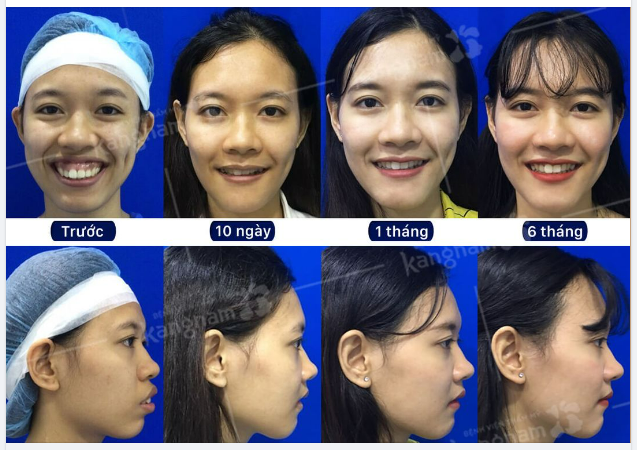 Hành trình thay đổi của cô gái hàm hô sau 6 tháng