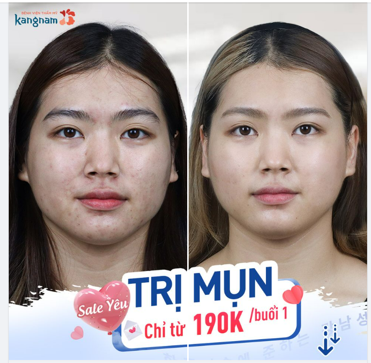Tháng Yêu tặng Sale Yêu - TRỊ MỤN chỉ từ 190k