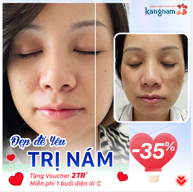 Hết nám, sáng da - Sale "Yêu" tặng nàng
