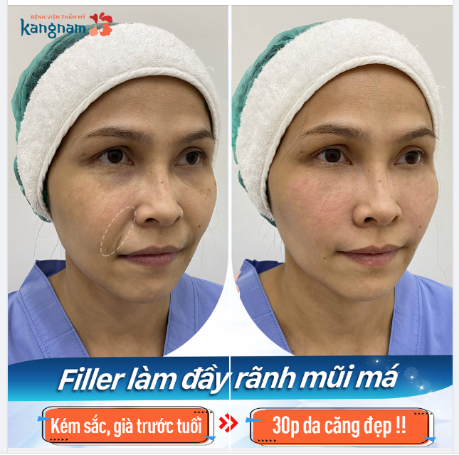 Rãnh cười hẳn sâu​​​​​​​Tự động cộng thêm vài tuổi cho gương mặt. Bạn có gặp tình trạng này?