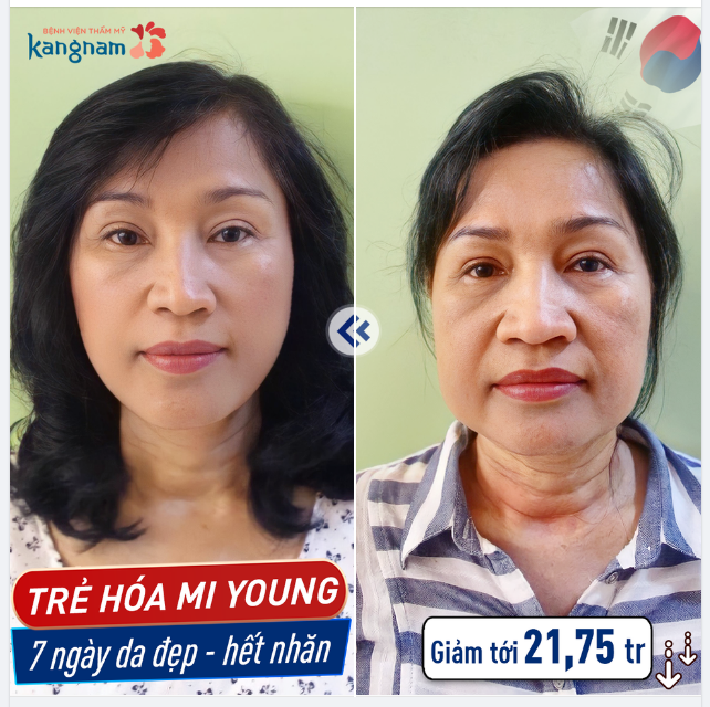 Da chảy xệ - Nếp nhăn - Rãnh cười sâu