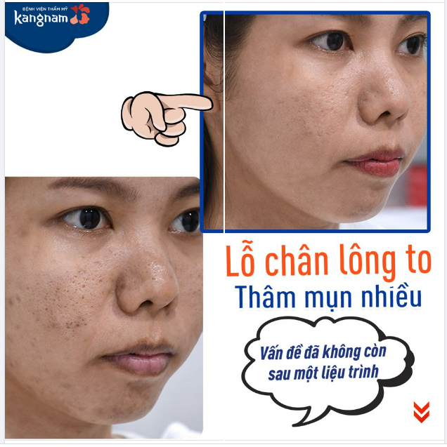 Da sẹo, nhiều thâm mụn và không có người yêu
