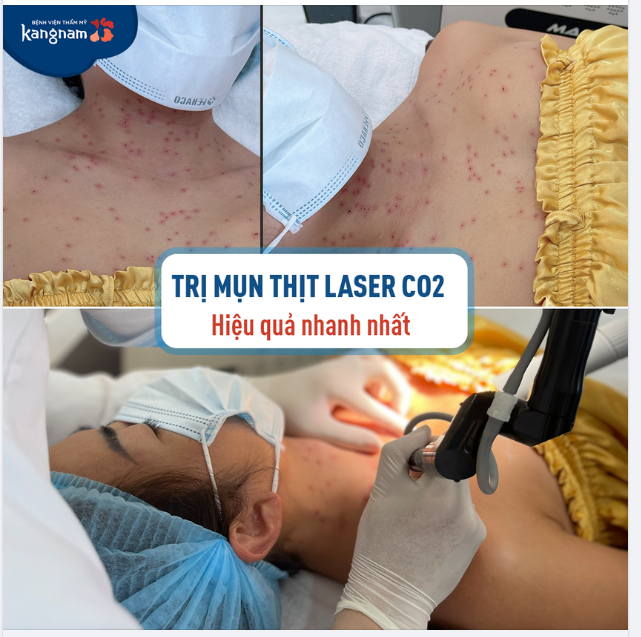 Khách hàng gặp tình trạng mụn thịt "chi chít" quanh vùng cổ