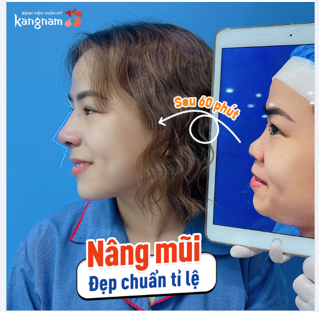 60 phút có ngay mũi đẹp chuẩn tỉ lệ với combo nâng mũi + cắt cánh mũi