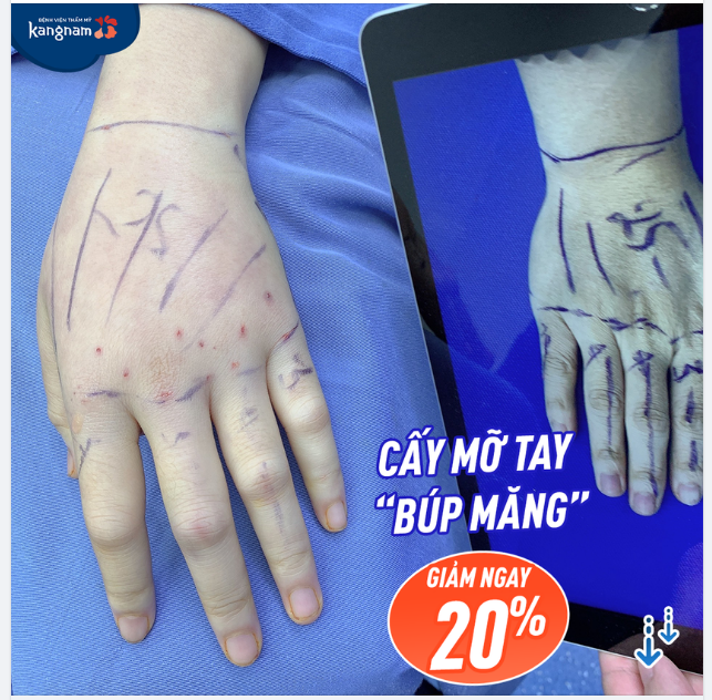 Cấy mỡ tay- Tay đẹp, căng mịn tức thì