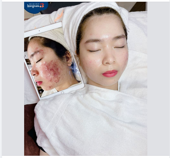 Trị mụn Công nghệ cao OFF 50% chỉ từ 0Đ