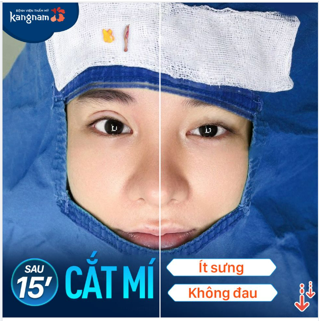 Cắt mí vừa xong trông sẽ như thế nào??