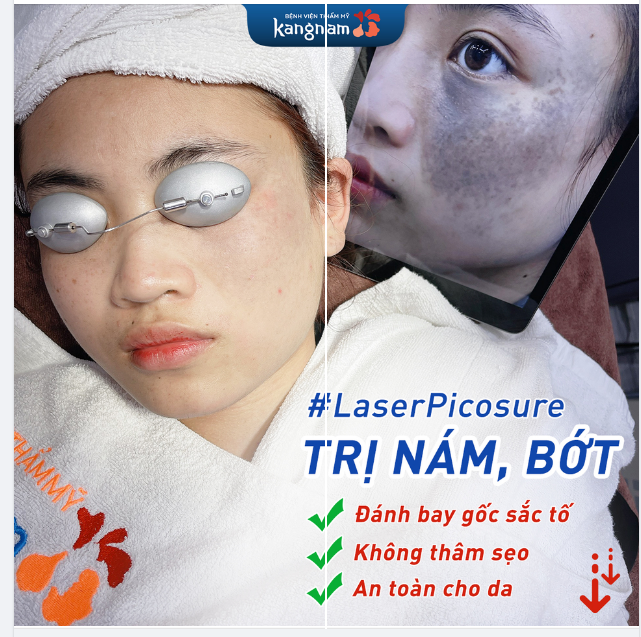 Kết quả 10 buổi trị bớt với Laser Picosure