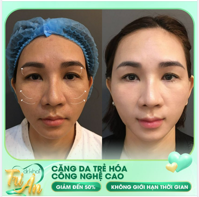 CĂNG DA TRẺ HÓA CÔNG NGHỆ CAO GIẢM NGAY 30 - 50%