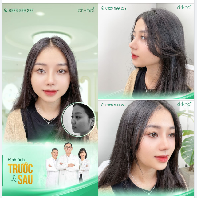 NÂNG MŨI CẤU TRÚC 1 THÁNG - XINH NHƯ HOTGIRL