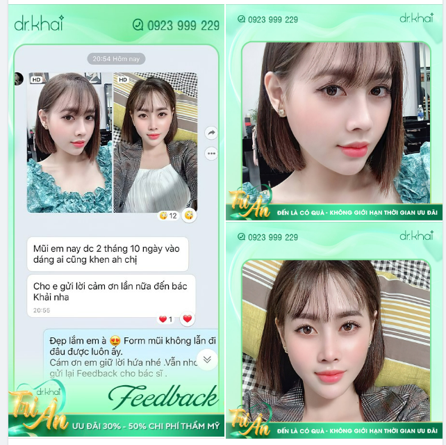 KHÁCH XINH HÀI LÒNG VỚI DÁNG MŨI SAU 2 THÁNG 10 NGÀY