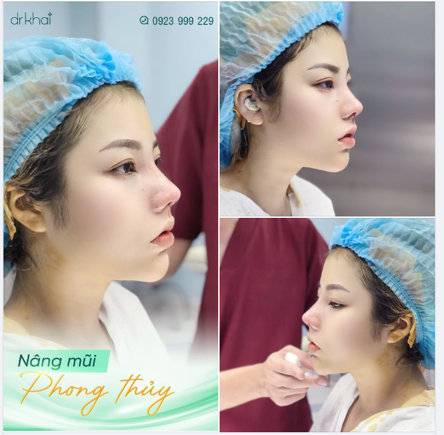 CHƯA RA KHỎI PHÒNG PHẪU THUẬT NHƯNG MŨI KHÁCH ĐÃ RẤT ĐẸP - ƯU ĐÃI NGAY 50%!!